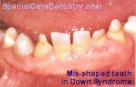 Mis-shapen Teeth