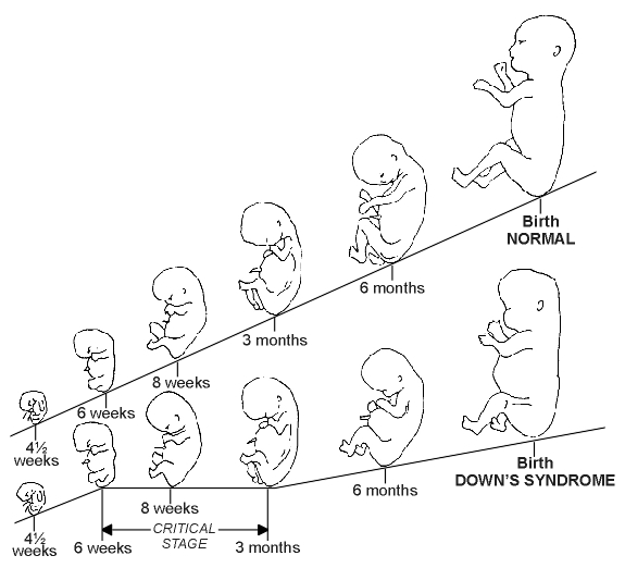Growth of the Down's Syndrome Foetus Compared with Normal