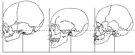 Lateral Views of Normal and Down's Syndrome Skulls