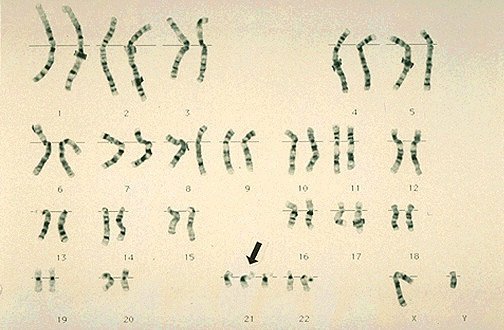 karyotype male. Trisomy 21 Karyotype (Male)